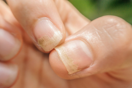 Onychomycosis or Fungal nail infection on thumb and forefinger