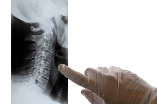 A doctor in white gloves points a finger at an x-ray of the cervical spine. Close-up. Concept on a medical theme, day of radiologist. Isolate. Copy space.