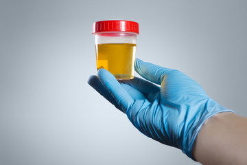 Hand in a blue glove holding medical urine test on gray background