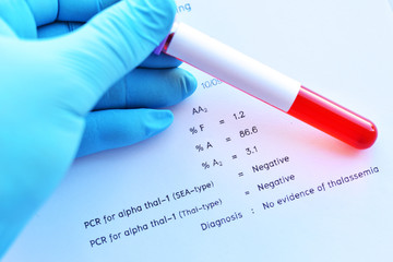 Laboratory result of hemoglobin typing test with blood sample
