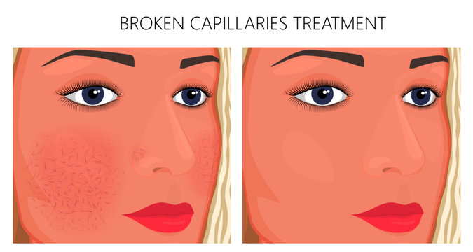 Vector illustration. Broken capillaries on face skin (cheeks, nose) before, after treatment. For advertising of medicinal, pharmacy products, cream, cosmetic procedures, medical publications