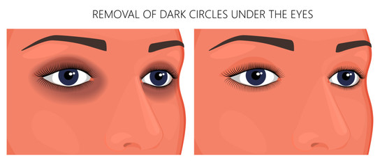 Vector illustration. Female eyes with dark circles around the eyes and without dark circles. For advertising funds for the treatment of this problem and medical publications about it.