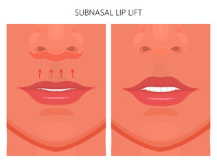 Vector illustration. Subnasal lip lift steps on women face, after procedure. Close up view. For advertising of medicinal, cosmetic and plastic surgery and procedures