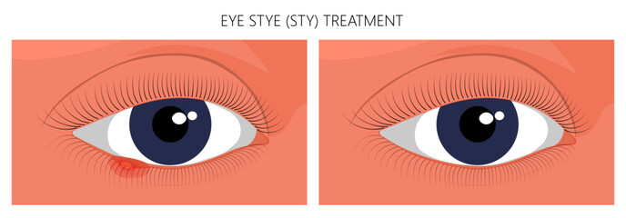 Vector illustration. Eye Stye (Sty) problem before and after treatment. Close up view. For advertising, medicinal publications