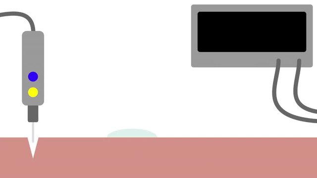 Electrosurgery Current Density Animation without Labeling