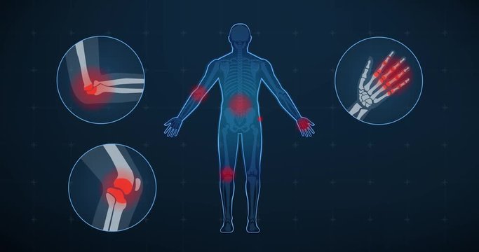 Joint inflammation and medical treatment
