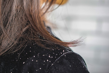  closeup woman hair with dandruff falling on shoulders - obrazy, fototapety, plakaty
