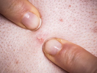 Woman dealing with pimples red spots