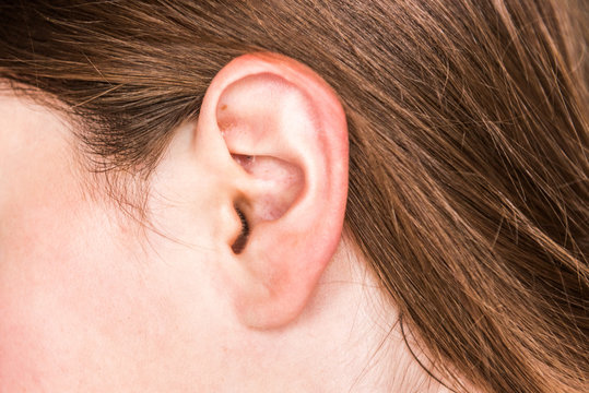 Acne inside the female ear. 