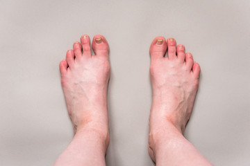 Fototapeta premium Damaged toenail on big toe on gray background. Callus on foot.