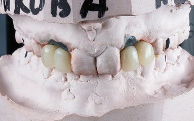 fitting of crowns on Dental models of the upper jaw of the patient © Dental Pro Content