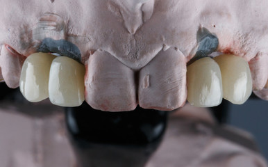 two pairs of Dental crowns on the model of the upper jaw © Dental Pro Content