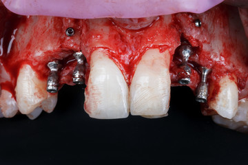 abutments and soft tissue build-up after implantation
