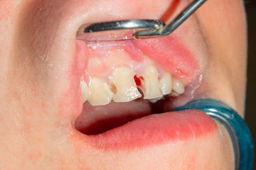two chewing side teeth of the upper jaw after treatment of caries. Restoration of the chewing surface with a photopolymer filling material using the Rubber Dam system © Сергей Кучугурный