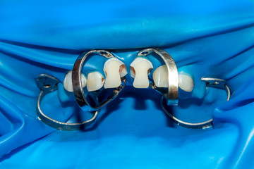 two chewing side teeth of the upper jaw after treatment of caries. Restoration of the chewing surface with a photopolymer filling material using the Rubber Dam system © Сергей Кучугурный