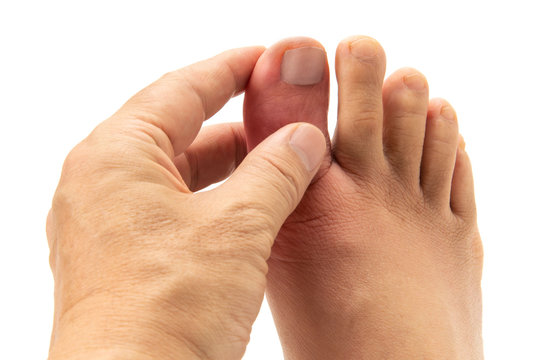 痛風の足指