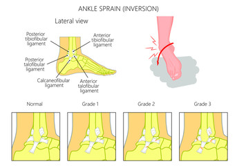 Mechanism of formation of an ankle sprain and Grades of an ankle sprain (Inversion) illustration with external and skeletal (lateral) view