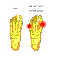 Illustration of the normal foot, valgus deviation of the first toe  and tailor's bunion.