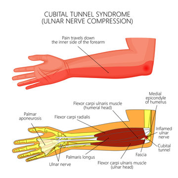 Illustration of Cubital tunnel syndrome or ulnar nerve impingement.