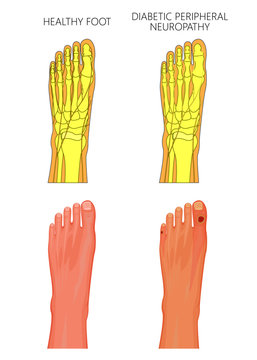 Illustration of Diabetic Peripheral Neuropathy. Healthy foot and foot with damaged nerves and ulcers on the toes