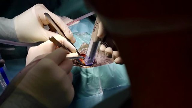 assistant of neurosurgeon is fixing clamps on skin of head of patient during operating of trepanation