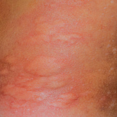 Fototapeta premium Allergy skin back and sides. Allergic reactions on the skin in t