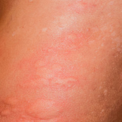 Fototapeta premium Allergy skin back and sides. Allergic reactions on the skin in t