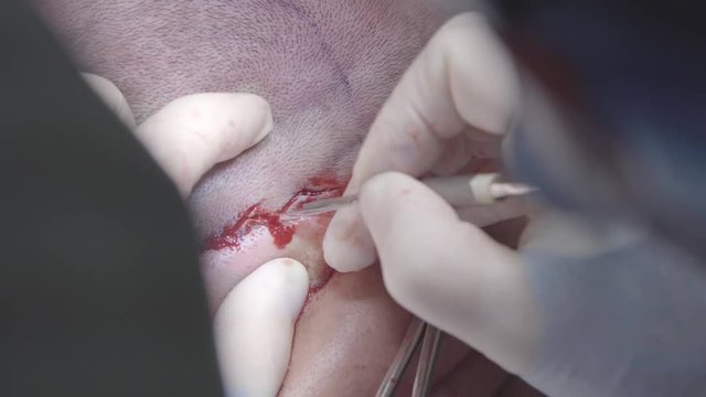Surgeon makes accurate small incision with scalpel during the plastic surgery (4K, 25fps)