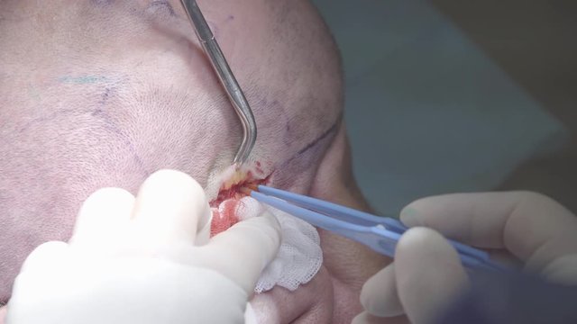 Hands of surgeon cauterize the incision with surgical coagulator and cuts the tissues of a wound close-up (4K, 25fps)