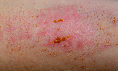 Wound on the skin. Scab. The wound heals. Skin diseases.