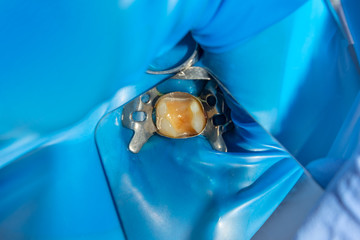two chewing side teeth of the upper jaw after treatment of caries. Restoration of the chewing surface with a photopolymer filling material using the Rubber Dam system © Сергей Кучугурный