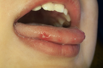 Boca  de niño afectado por herpangina