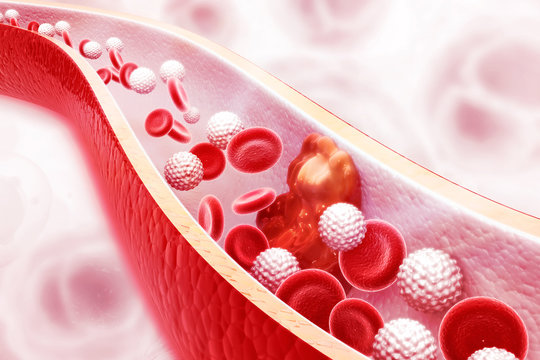 Cholesterol plaque in artery on science background