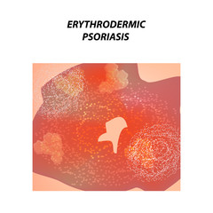 Erythrodermic psoriasis. Eczema, dermatitis skin disease psoriasis. Infographics. Vector illustration on isolated background.