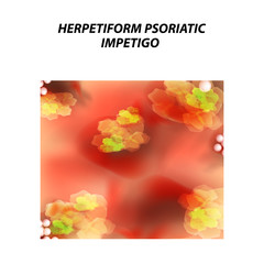 Herpetiform psoriatic impetigo. Eczema, dermatitis skin disease psoriasis. Infographics. Vector illustration on isolated background.