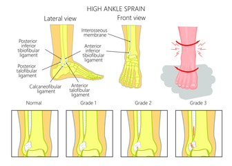 Illustration of Mechanism of formation of a High ankle sprain  (Syndesmotic Sprain) and Grades of high ankle sprain with external and skeletal (lateral and front) view of an ankle. - obrazy, fototapety, plakaty