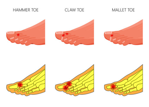 Illustration of the deformation of toes