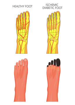 Illustration of an Ischemic Diabetic Foot with gangrene of the toes of the foot
