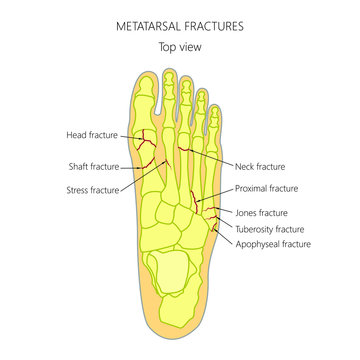 Illustration (diagram) of Metatarsal fracture types.