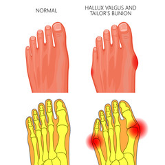 Illustration of the normal foot, valgus deviation of the first toe  and tailor's bunion. External and skeletal views. - obrazy, fototapety, plakaty