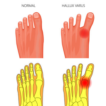 Illustration of the normal foot and hallux varus