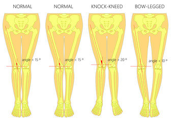 Vector diagram. Shapes of the  legs. Normal and curved legs. Knock knees. Bowed legs. Genu valgum and genu varum.