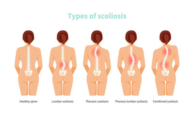 Types of scoliosis vector