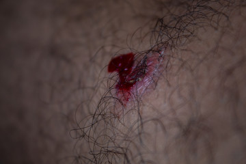 injury - painful knee wound accident. Close up on an bleeding scraped  knee after run accident. closeup