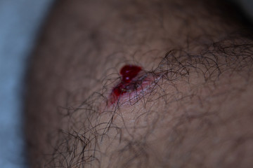 injury - painful knee wound accident. Close up on an bleeding scraped  knee after run accident. closeup