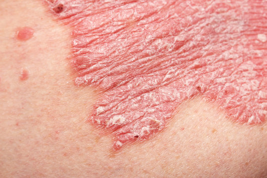 Detail of psoriatic skin disease Psoriasis Vulgaris with narrow focus, skin patches are typically red, itchy, and scaly