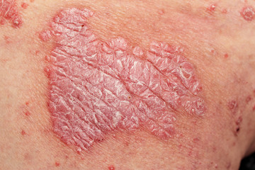 Detail of psoriatic skin disease Psoriasis Vulgaris with narrow focus, skin patches are typically red, itchy, and scaly - obrazy, fototapety, plakaty