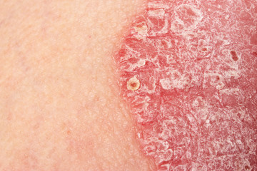 Fototapeta premium Detail of psoriatic skin disease Psoriasis Vulgaris with narrow focus, skin patches are typically red, itchy, and scaly