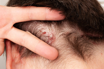 Detail of psoriatic skin disease in hair Psoriasis Vulgaris with narrow focus, skin patches are typically red, itchy, and scaly