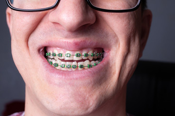 Braces and brackets on teeth, stamotology of medecine alignment of teeth orthodontist